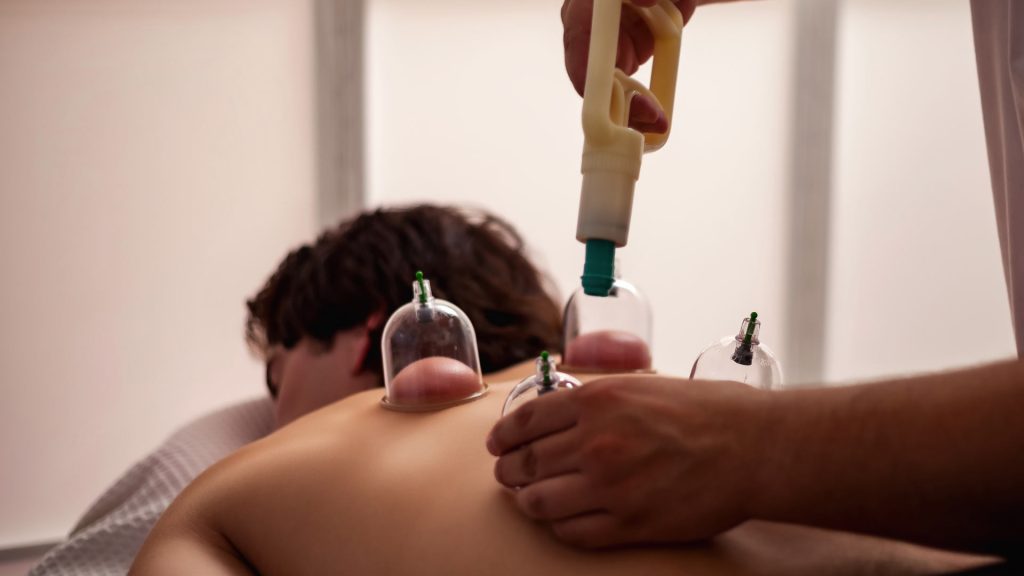 Hijama wet cupping therapy