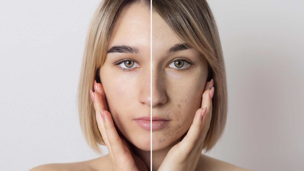 Skin boosters and fillers