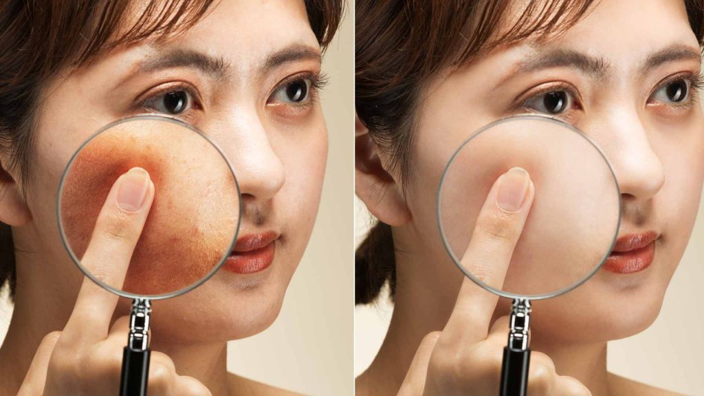 Dermal fillers