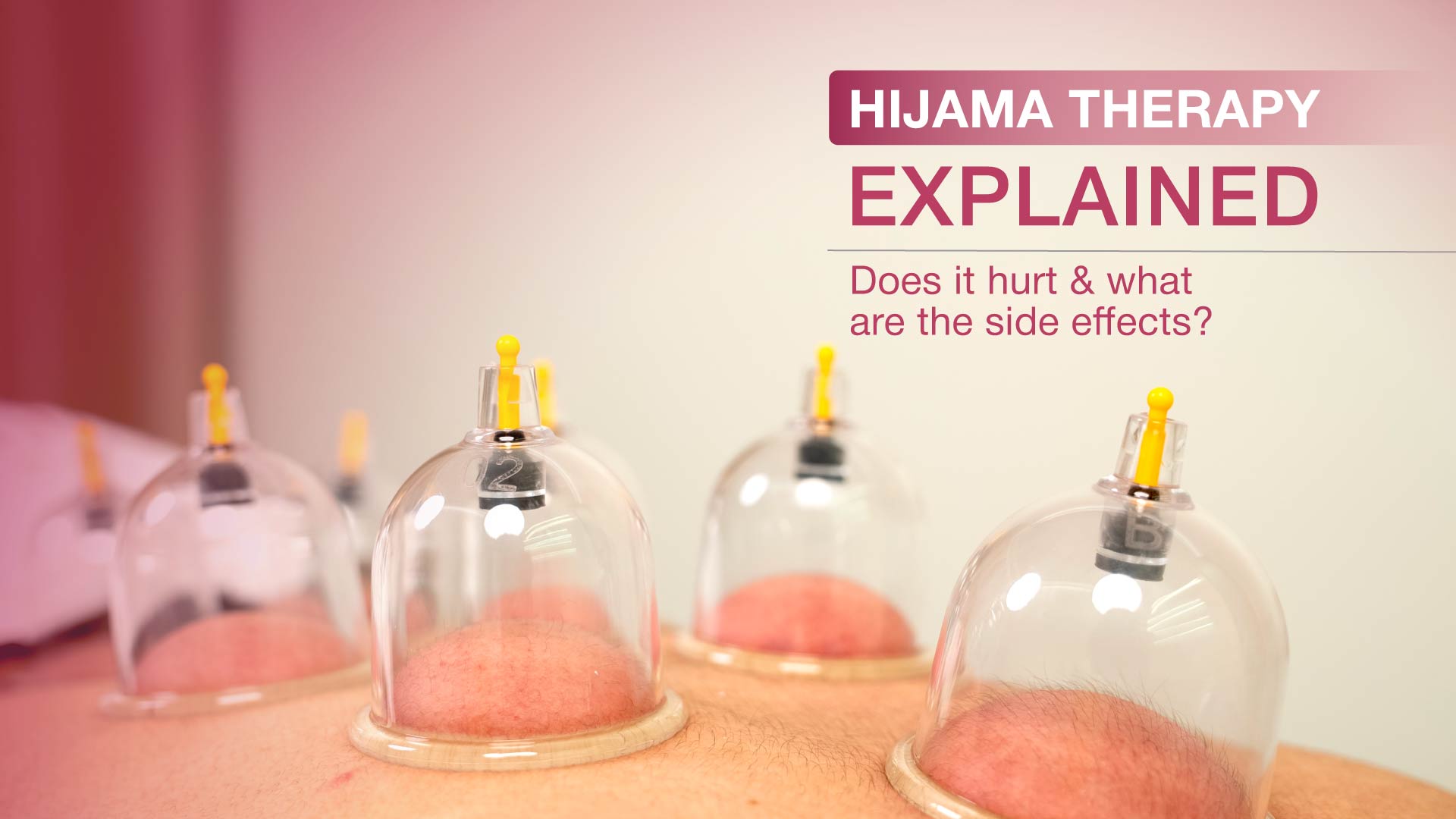 Hijama Therapy Explained: Does It Hurt and What Are the Possible Side Effects?