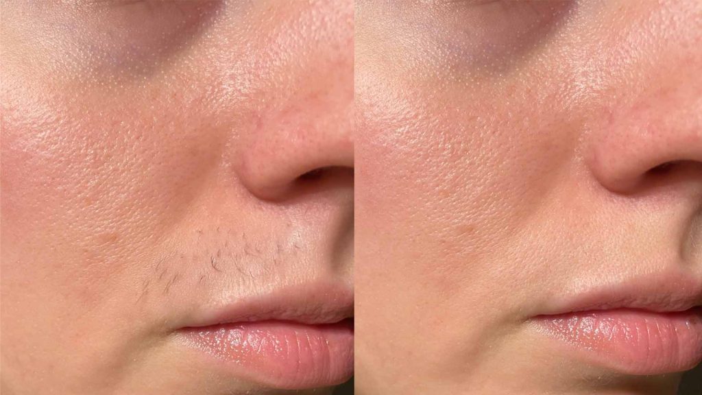 Why choose Amara for Laser hair treatment