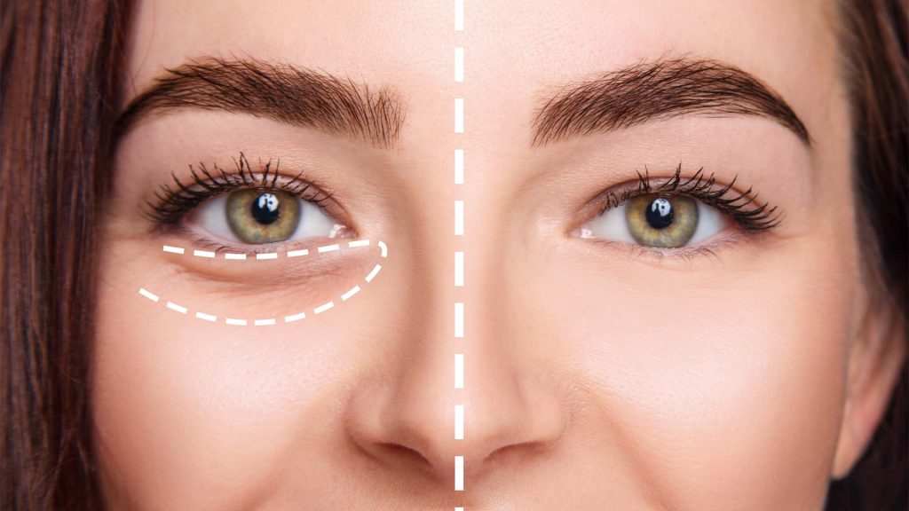 Popular Under-Eye Rejuvenation Treatments