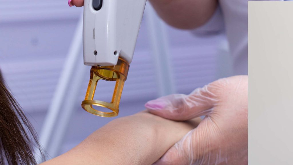 Laser Hair Removal machine