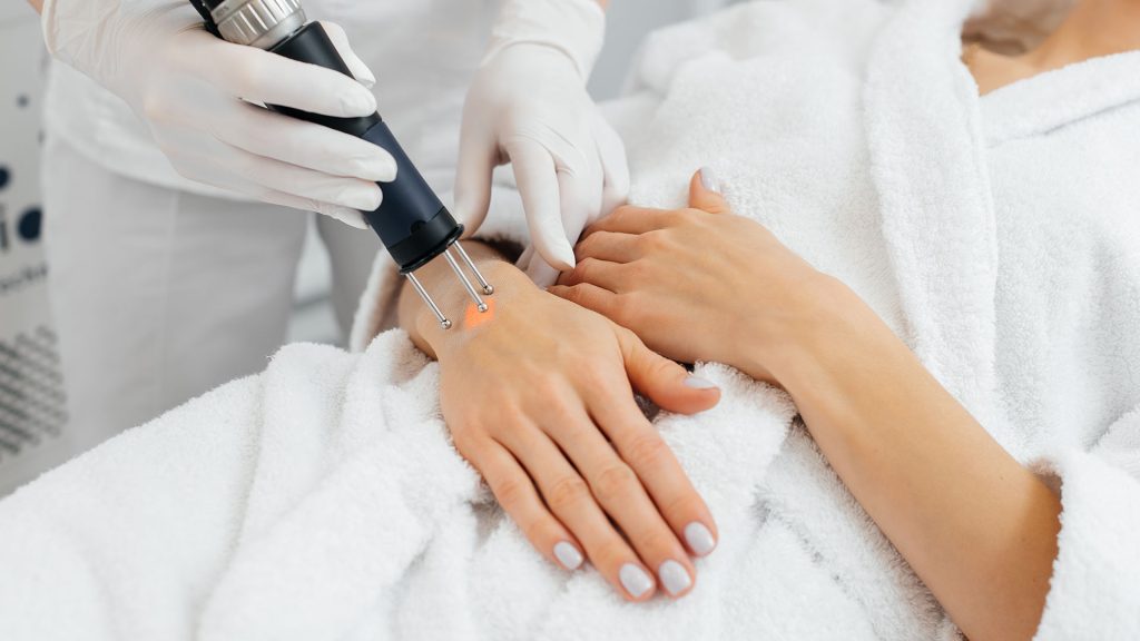 Carbon laser treatment