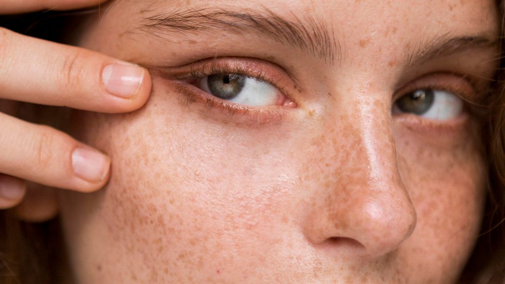 Melasma - a pigmentation type
