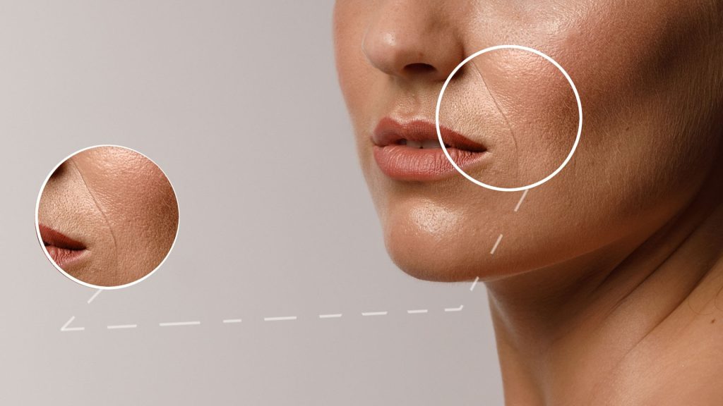 Nasolabial Folds: Softening Smile Lines