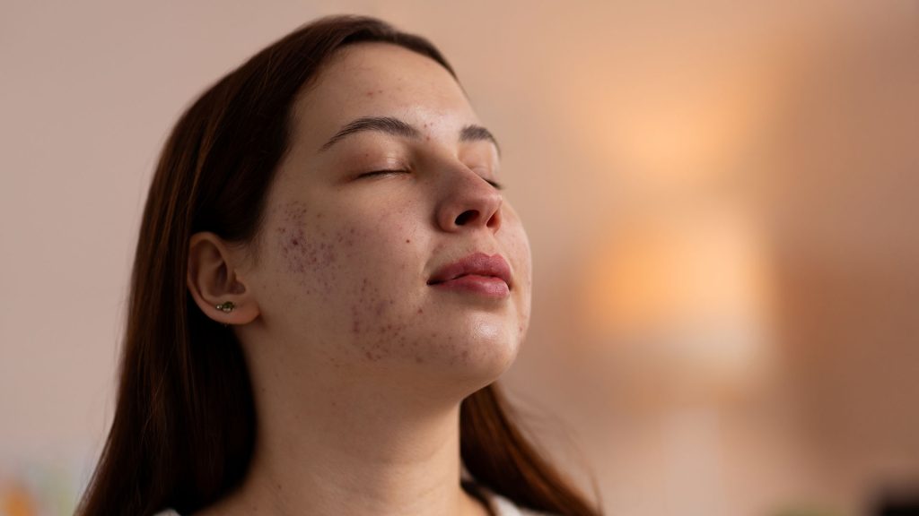 Ways to Treat and Remove Pigmentation