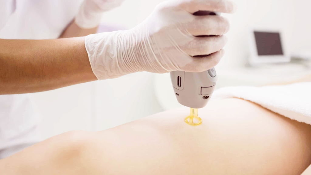 Pain and Sensitivity in Laser Hair Removal: What to Expect