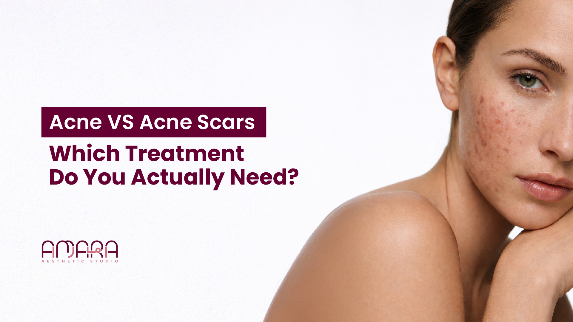 Acne vs Acne Scars? How to Choose the Right Treatment for Your Skin