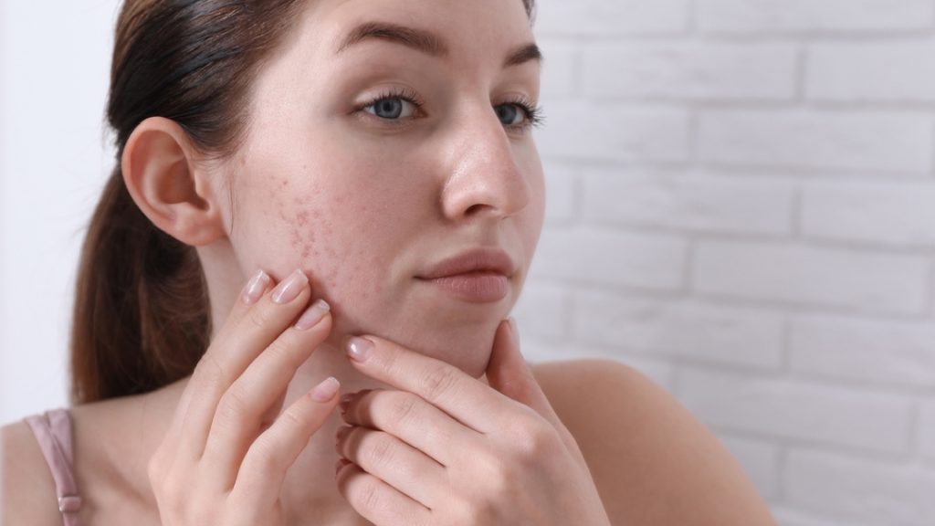 What Are Acne Scars?
