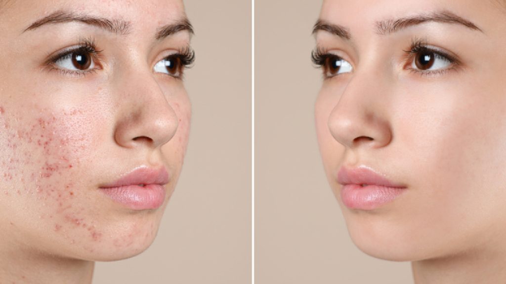 What are the Effective Treatments for Active Acne?