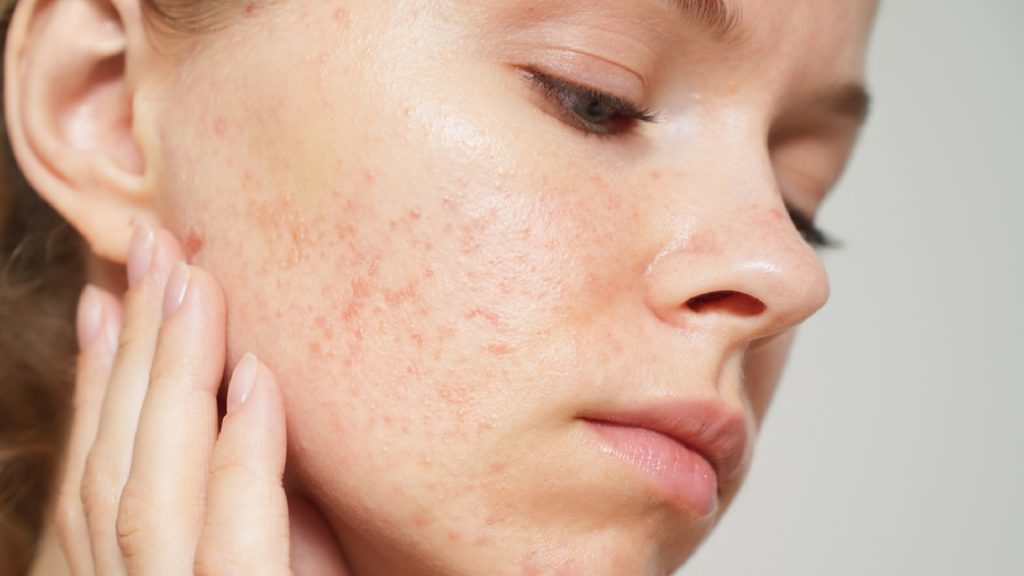 Can Acne and Acne Scars Be Treated Together?