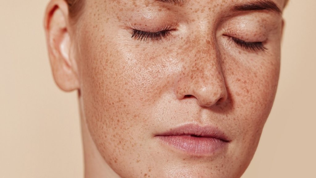 Heat and Infrared Radiation causes pigmentation