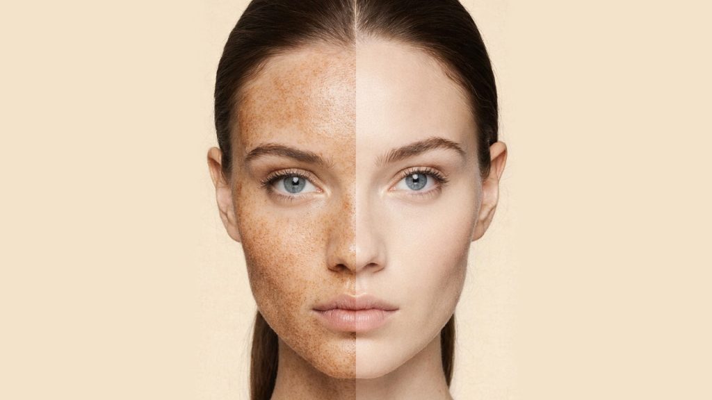 What Actually Prevents Sun-Induced Pigmentation?