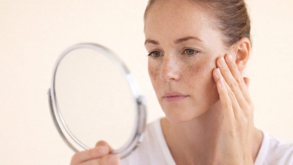 Types of Pigmentation Caused by Sun Exposure