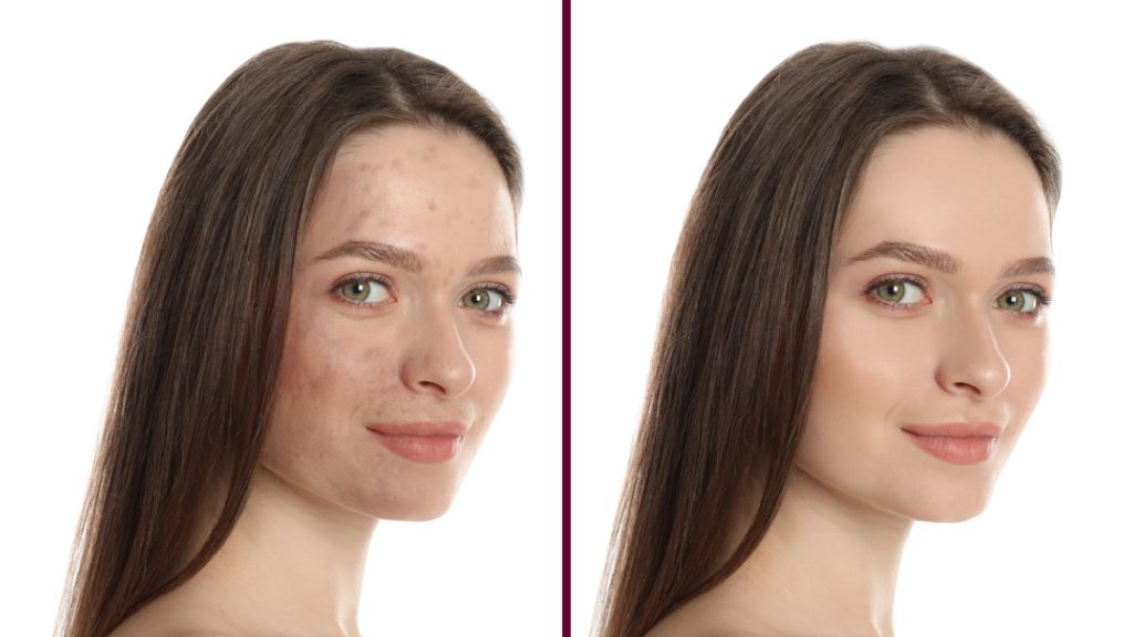 Laser Treatment for Pigmentation