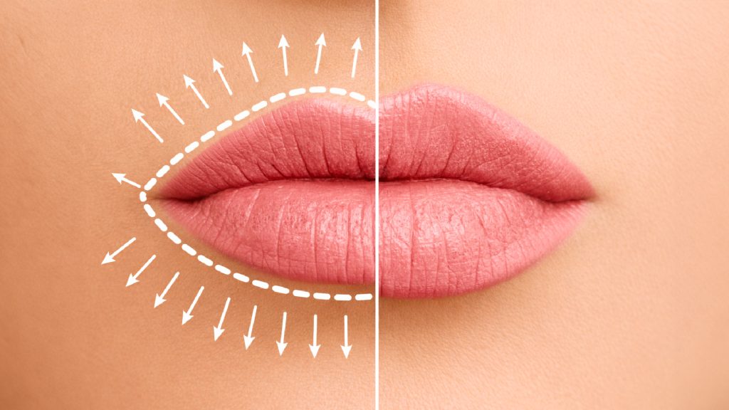 Lip Fillers in Dubai