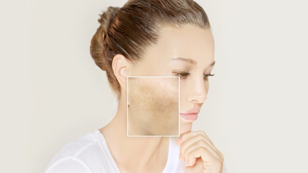 What Is Melasma?