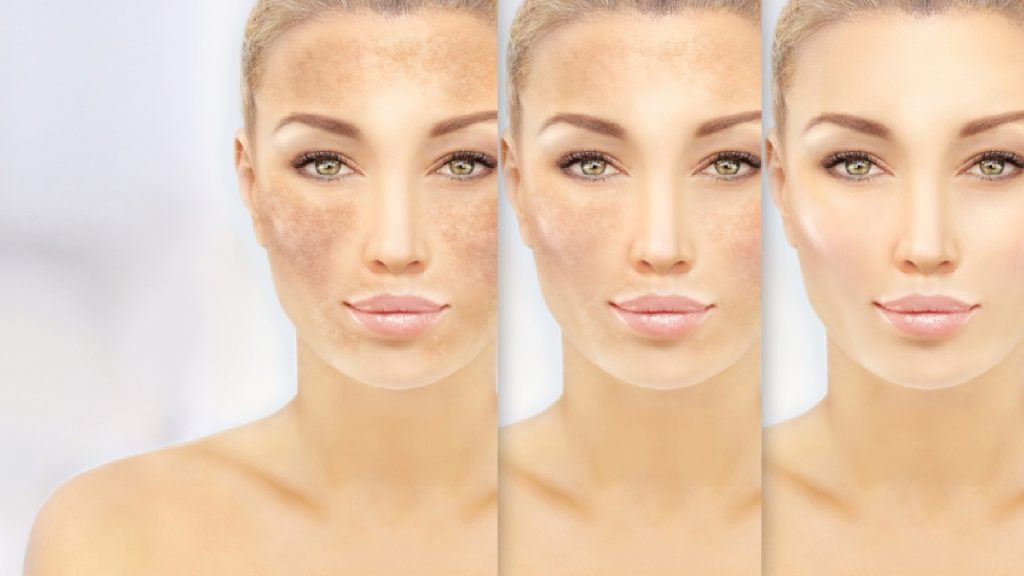 What Causes Dark Spots?