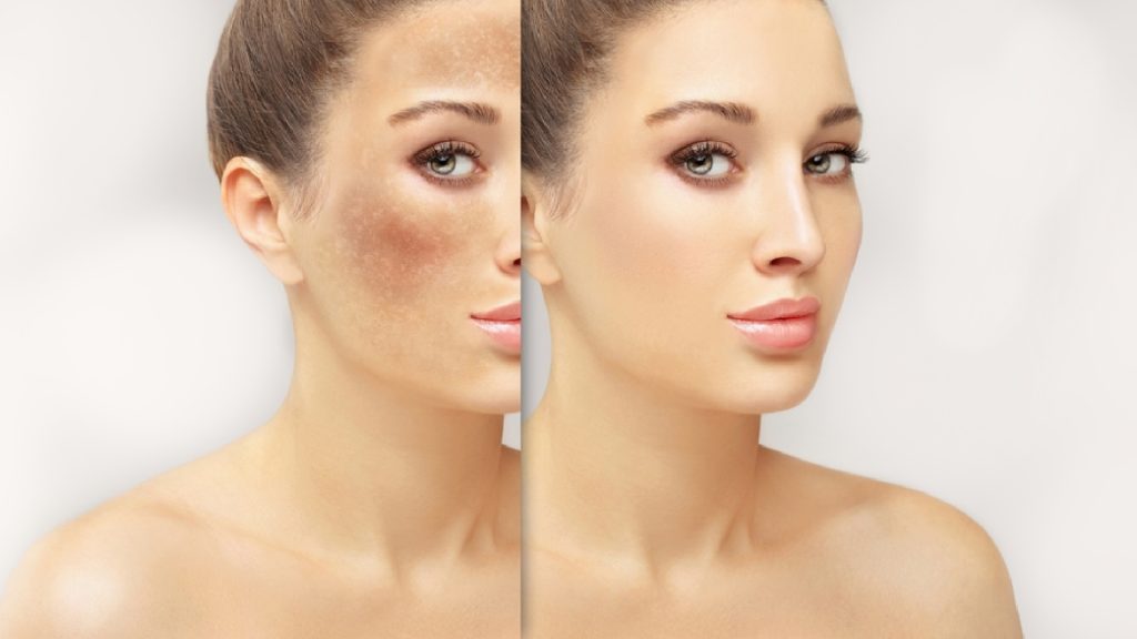 Chemical Peel for Melasma in Dubai