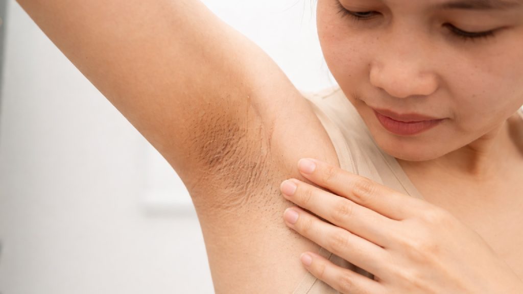 Who Can Benefit from Underarm Laser Hair Removal?
