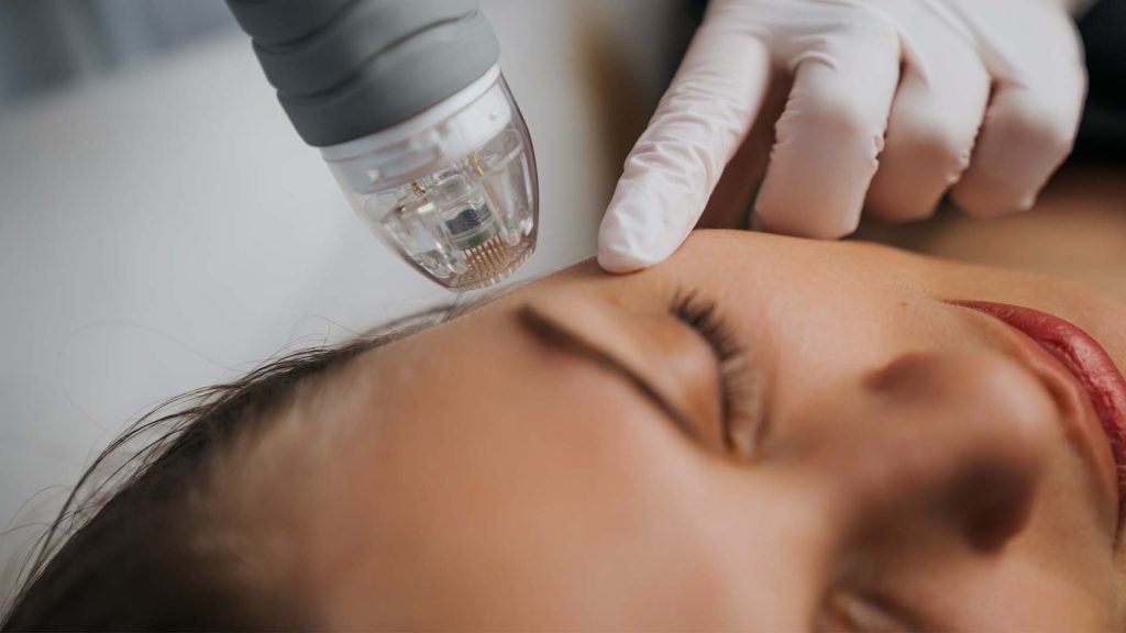 What are the Benefits of RF Microneedling in Dubai