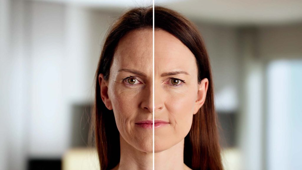 What are the Uses of Juvéderm Ultra 4? 